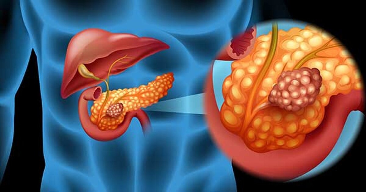 Spanish Scientists Achieve Breakthrough in Pancreatic Cancer Treatment